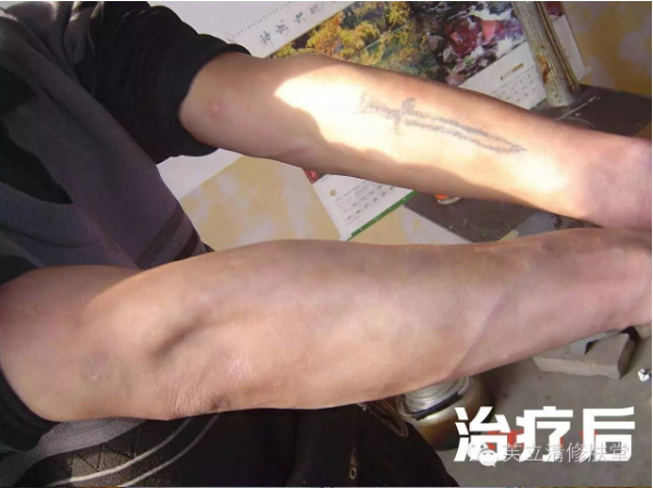牛皮癬套盒