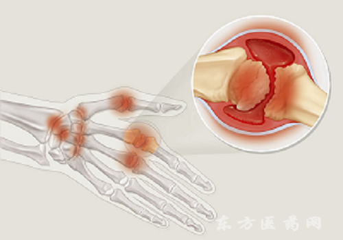 風(fēng)濕類(lèi)風(fēng)濕1