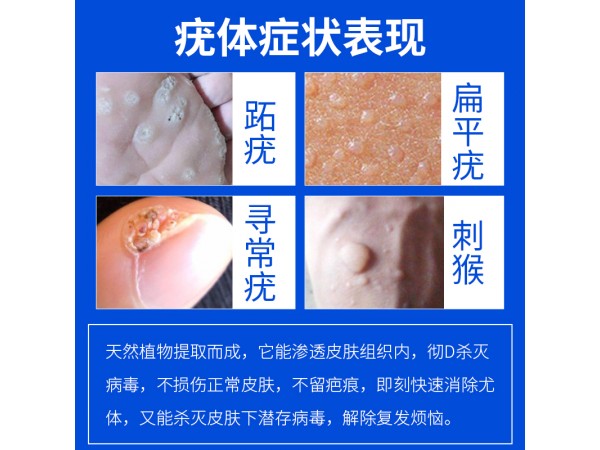 溢美消疣靈