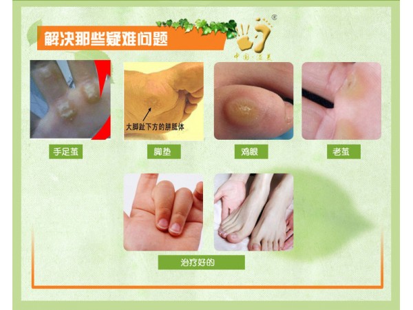 溢美雞眼膏