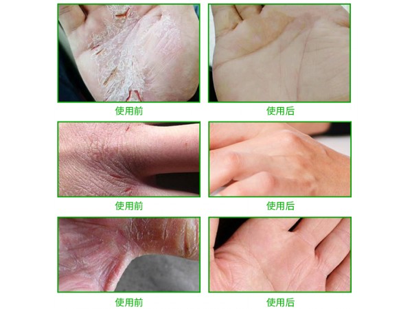 溢美愈合膏