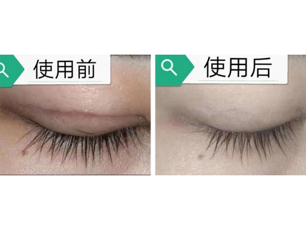 呂易圣掃疤燙皮膚抑菌液